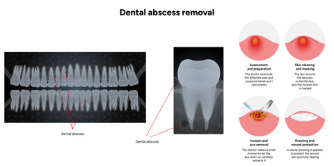 Hand-drawn dental illustration showing the process of dental abscess removal, including the infected tooth, drainage, and cleaning stages. With x ray illustration 