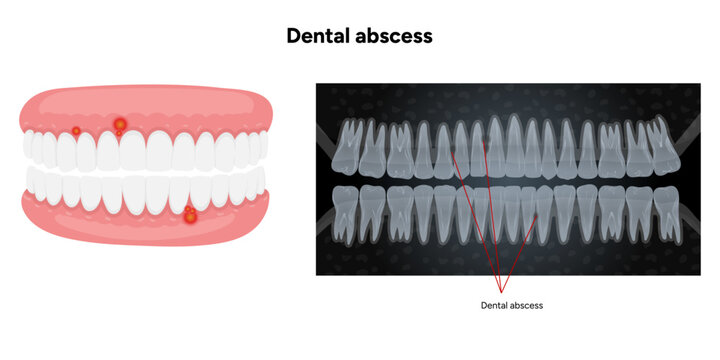 Hand-drawn dental infographic showing upper and lower teeth with dental abscess, including detailed jaw illustration