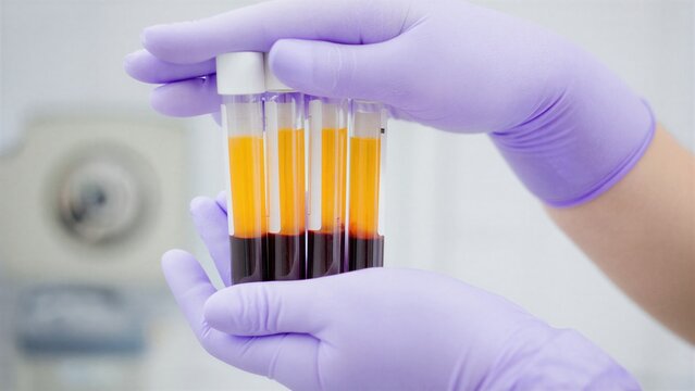 Test tubes with centrifuged blood in medical laboratory, platelet-rich plasma preparation, autologous treatment, rejuvenation therapy, non-surgical procedure, regenerative medicine