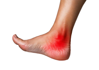 Inflamed heel (Turns slightly red). isolated on transparent or white background