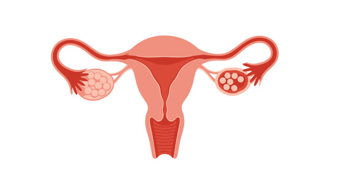 Anatomical illustration of the female reproductive system showing polycystic ovary syndrome with multiple cysts on the ovaries.