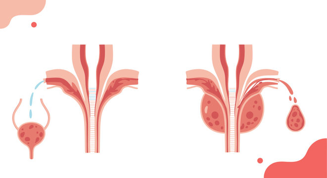 Medical illustration comparing a normal prostate and urethra with benign prostatic hyperplasia, showing urinary flow obstruction.