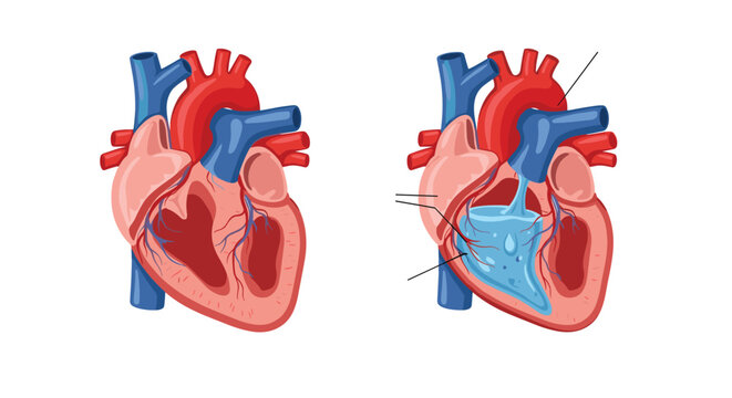 Comparison illustration of a normal heart cross-section versus a heart with pericardial effusion, showing fluid buildup around it.