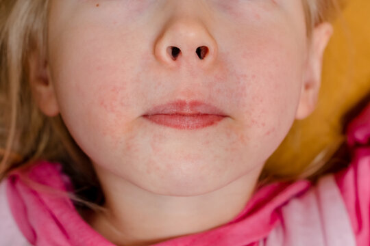 Rash around the child's mouth, dermatitis