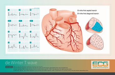 De Winter T wave is an electrocardiographic manifestation of acute coronary syndrome, where the culprit vessel is severe stenosis of the proximal left anterior descending artery.
