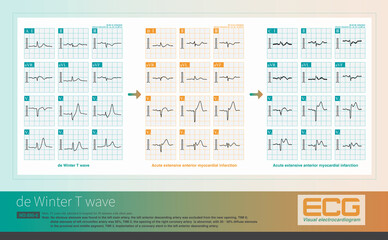 When the ST segment of the de Winter T wave changes from depressed to elevated, it indicates progression to acute AMI, with myocardial ischemia spreading from subendocardial to epicardial.
