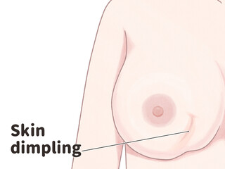 Breast cancer symptoms Skin dimpling Medical diagram PNG