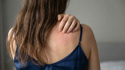 Obraz premium A young woman is seen from behind, intensely scratching a visible red, itchy skin rash on her upper back. This image depicts discomfort from an allergic reaction or skin irritation.