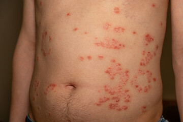 Psoriasis patches on torso exhibit redness and scaling in indoor setting