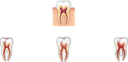 Medical dental anatomy diagram of healthy and infected tooth with root canal treatment showing inflamed red pulp and nerve for dentistry healthcare education concept.