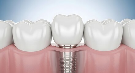 Dental Implants and Human Teeth Placement 3D Model