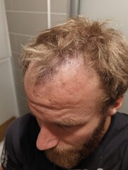 Obraz premium Person With Short, Messy Hair Showing Signs of a Recent Head Injury in an Indoor Setting, Likely at Home After an Accident