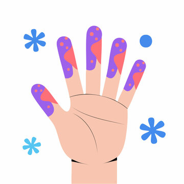 Illustration of a hand with symptoms of frostbite or Raynauds disease.