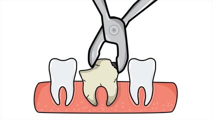 Medical Animation: Damaged Tooth Removal Procedure (Tooth Extraction) with Forceps