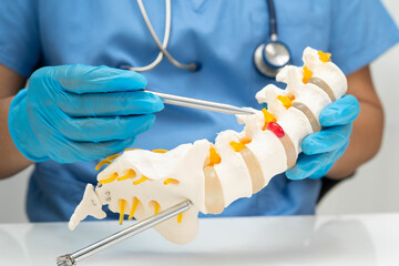 Asian doctor holding spinal nerve and bone model, Lumbar spine displaced herniated disc fragment for treatment medical in the orthopedic department.