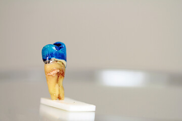 Crowned tooth with root, discolored blue