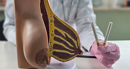 Doctor holds cigarettes and model of female breast. Nicotine promotes metastasis of breast cancer...