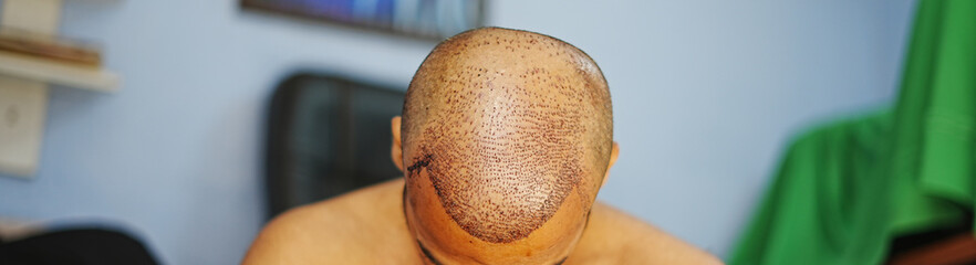 Wide frontal photograph of a freshly transplanted scalp showing newly implanted grafts extending across the hairline.