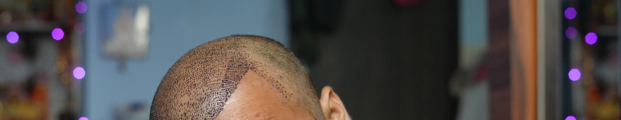 Close-up side view of the scalp after a hair transplant procedure, showing implanted grafts and early healing along the side hairline.