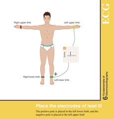Lead Ⅲ is a standard limb lead, with the positive pole placed in the left lower limb and the negative pole placed in the left upper limb.
