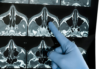 Hand in blue medical glove points at CT examination of the paranasal sinuses xray film