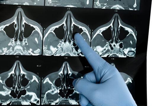 Hand in blue medical glove points at CT examination of the paranasal sinuses xray film