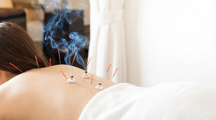 背中に鍼とお灸を施した鍼灸治療の施術風景。白基調のリラクゼーション空間で行われる東洋医学のケアイメージ｜Acupuncture and moxibustion therapy on the back in a clean white relaxation space representing traditional Oriental medicine