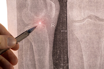 Doctor learn X-ray with narrowed joint space, compacted tibial endplate, exacerbation of intercondylar elevation of the tibia. Osteoarthritis of the knee joint.