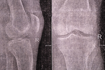 X-ray with Narrowed joint space, compacted tibial endplate, exacerbation of intercondylar elevation...