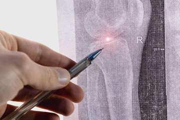Doctor learn X-ray with narrowed joint space, compacted tibial endplate, exacerbation of...