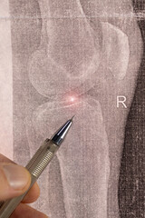 Doctor learn vertical X-ray with narrowed joint space, compacted tibial endplate, exacerbation of intercondylar elevation of the tibia. Osteoarthritis of the knee joint.