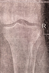 Doctor learn vertical X-ray with narrowed joint space, compacted tibial endplate, exacerbation of intercondylar elevation of the tibia. Osteoarthritis of the knee joint.