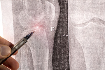 Doctor learn X-ray with narrowed joint space, compacted tibial endplate, exacerbation of...