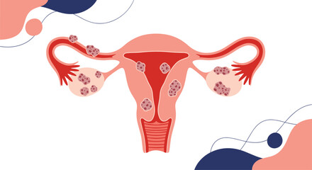 Medical illustration of the female reproductive system showing conditions like endometriosis or uterine fibroids affecting the uterus.
