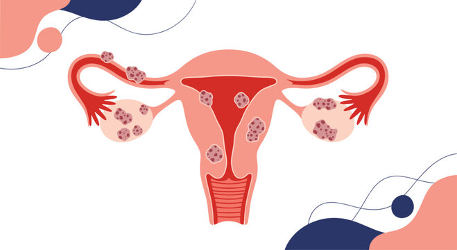 Medical illustration of the female reproductive system showing conditions like endometriosis or uterine fibroids affecting the uterus.
