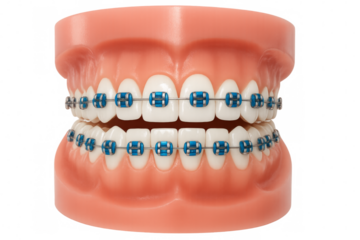 Dental model showing braces for orthodontics treatment concept