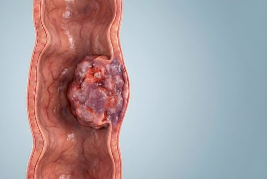 Colon Cancer Illustration showing Large Tumor in Intestine - 3D Medical Render