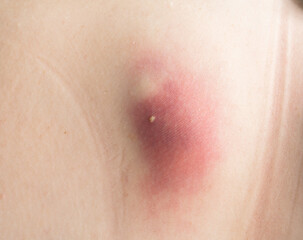 Macro close-up image of an inflamed boil filled with pus on human skin. Skin infection showing redness, swelling, and abscess. Medical dermatology condition.