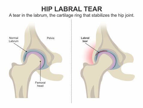 Hip labrum tear, Hip joint medical illustration flashcard