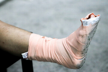 Close-up of a foot wrapped in a medical bandage, showing injury or sprain, with visible wear and texture, symbolizing healthcare, pain, recovery, and first aid treatment.