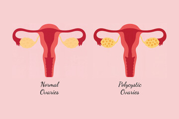 Comparison Diagram of Normal Ovaries and Polycystic Ovaries (PCOS) in the Female Reproductive System