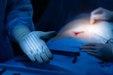 Surgeon's gloved hand holding surgical mesh after umbilical hernia removal in operating room