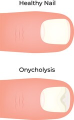 Comparison of Healthy Nail vs. Onycholysis (Nail Separation) Vector Illustration