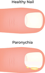 Paronychia Nail Infection Comparison Vector Illustration