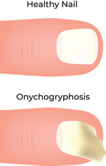 Healthy Nail vs Onychogryphosis A Visual Comparison Vector illustration