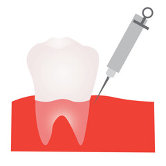 Dental Anesthesia Injection