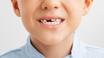 Close-up of a cheerful child with a gap from a fallen tooth.