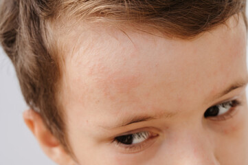 The Coxsackie virus. Symptoms on children's facial skin. Painful rash, red spots, blisters.