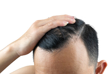 A close-up shot of an Asian man's hand resting on his thinning, dark hair, clearly showing signs of male pattern baldness (androgenetic alopecia) or hair loss at the hairline and crown.