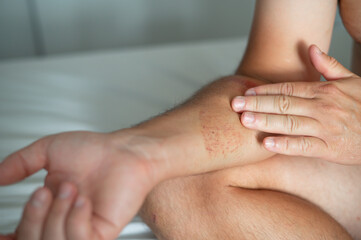 Close-up of an arm wound with applied healing ointment. Concept of first aid, wound care, and treatment of skin injuries.